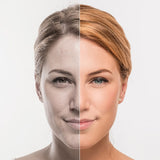 Profhilo Face & Neck 1/2