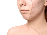 IPL Acne Face