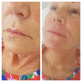 Sunekos Single Treatment