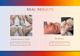 LED Light Therapy Facial
