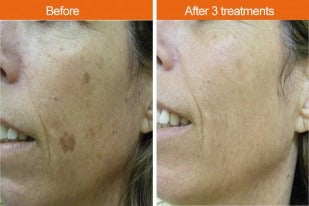 Ipl treatment deals for pigmentation