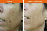 IPL Pigmentation Face