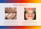 LED Light Therapy Facial