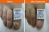 IPL Fungal Nail Infection