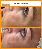 Chronus Filler Facial