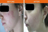 IPL Acne Face