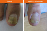 IPL Fungal Nail Infection