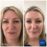 Profhilo Face & Neck 1/2