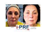 IPRF 'The Vampire-ish Facial'