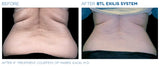 Exilis Ultra 360