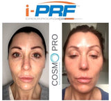 IPRF 'The Vampire-ish Facial'