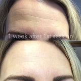 Sunekos Single Treatment