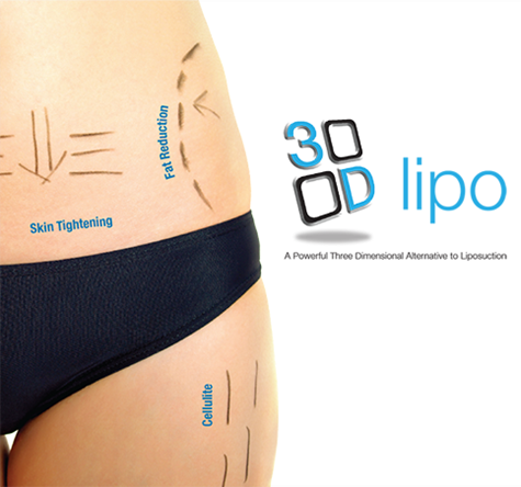 3D Lipo