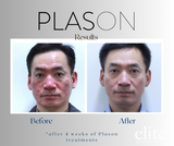 Plason Clear Acne Facial