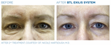 Exilis Ultra Eye Area Package of 6