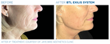 Exilis Ultra Lower Face and Neck Package of 6