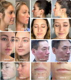 Plason Clear Acne Facial