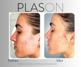 Plason Clear Acne Facial