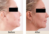 Exilis Ultra Lower Face and Neck Package of 6