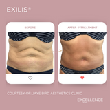 Exilis Ultra Abdomen and Flanks (Love Handles) Package of 6