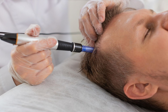 ExoHair - Exosomes with Dermapen