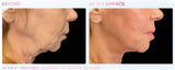 Emface Submental Area only ( Double chin and Jawline)