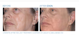 Exion RF Microneedling