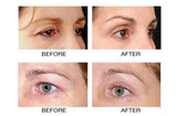 Carboxytherapy - Eye Rejuvenation