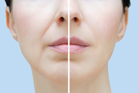 Nasolabial folds CONSULTATION IS REQUIRED PRIOR TO ANY TREATMENT .
