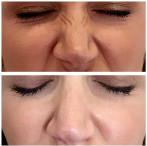 Bunny Lines                           This Treatment cannot be booked without a prior  ANTI WRINKLE INJECTION CONSULTATION