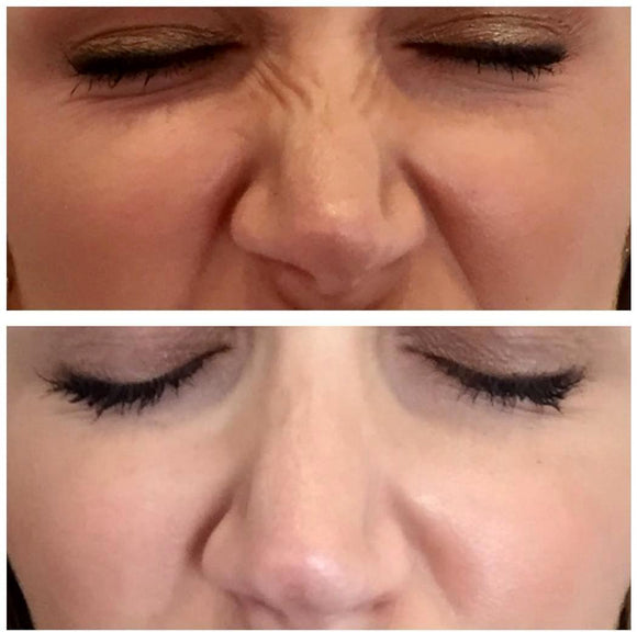 Bunny Lines                           This Treatment cannot be booked without a prior  ANTI WRINKLE INJECTION CONSULTATION