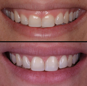 Gummy Smile - This Treatment cannot be booked without a prior  ANTI WRINKLE INJECTION CONSULTATION