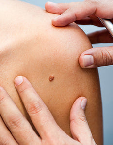 Plexr Skin Tag Removal