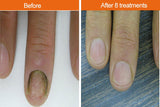 IPL Fungal Nail Infection