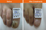 IPL Fungal Nail Infection