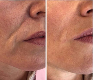 Marionette lines CONSULTATION IS REQUIRED PRIOR TO ANY TREATMENT .